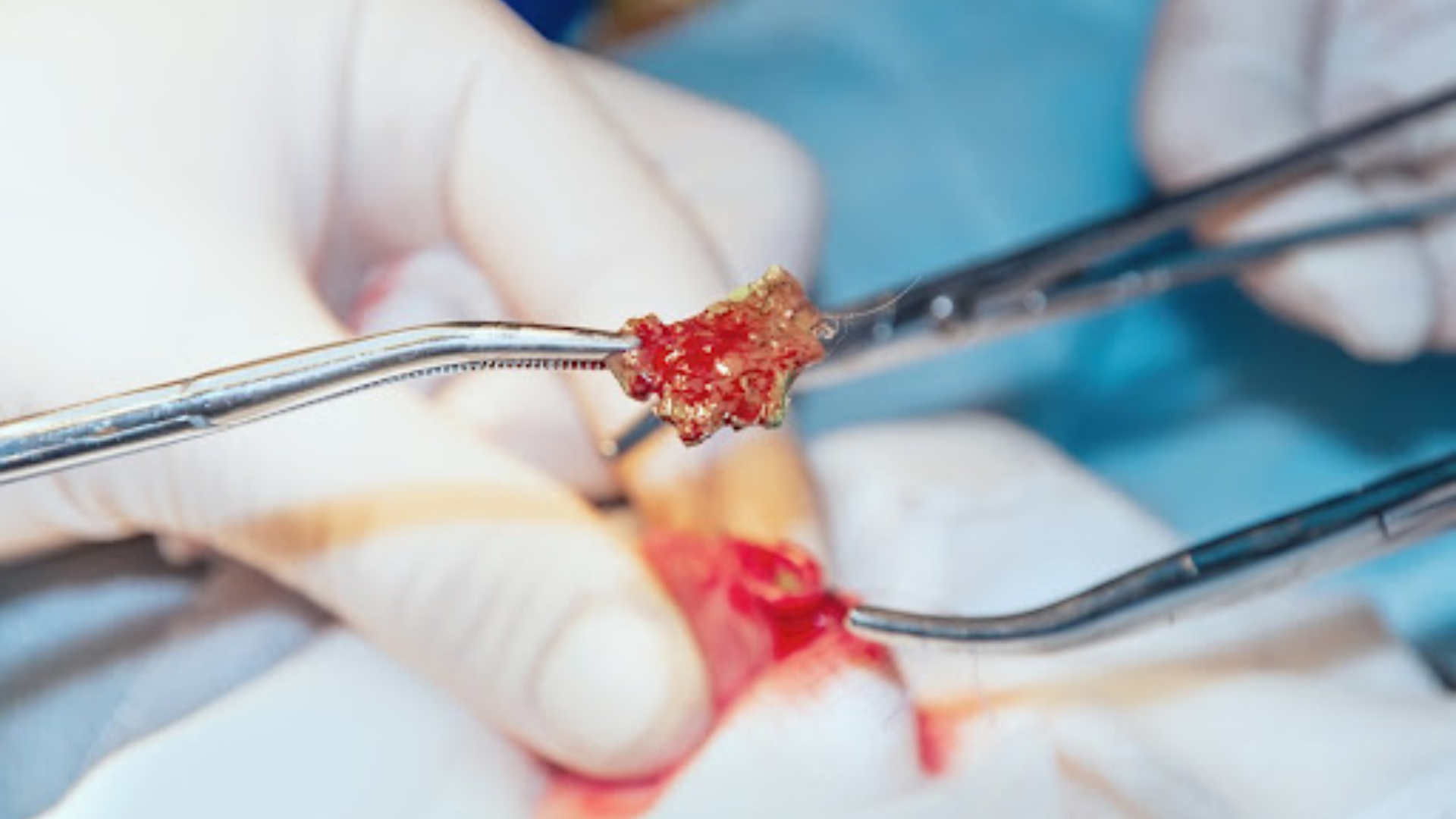 Surgical Procedures